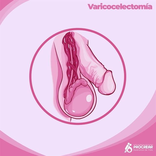 Varicocelectomia