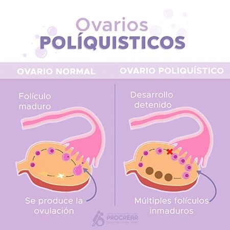  Ovario poliquístico