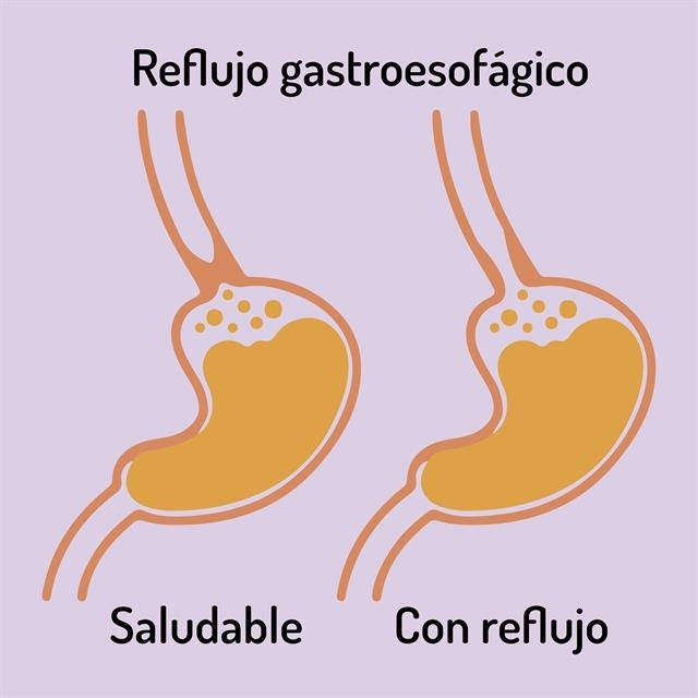 Gastric reflux