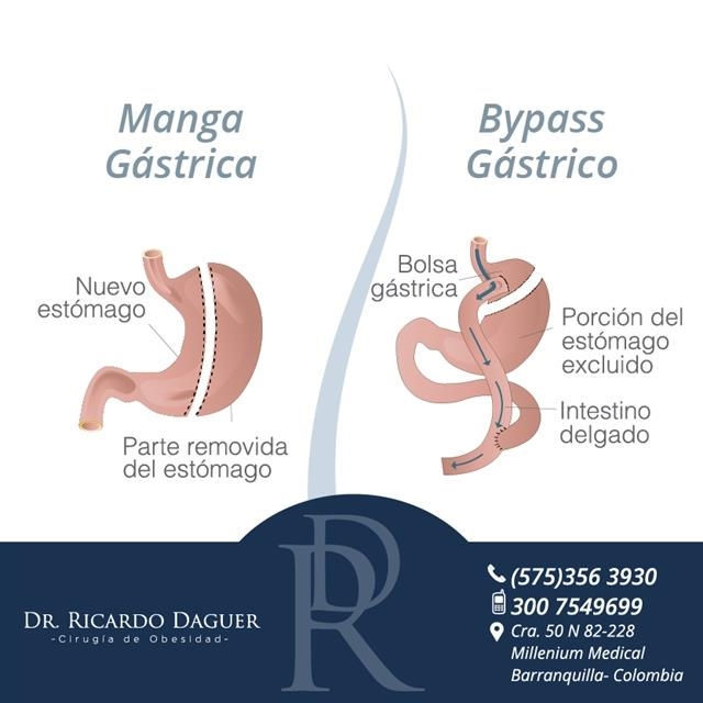 Gastric Bypass - Gastric Sleeve