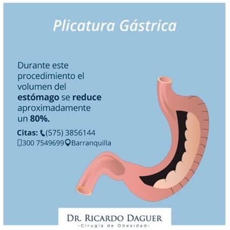 Gastric plication