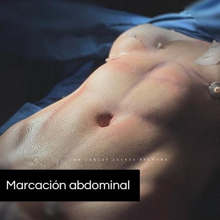 Marcación abdominal 