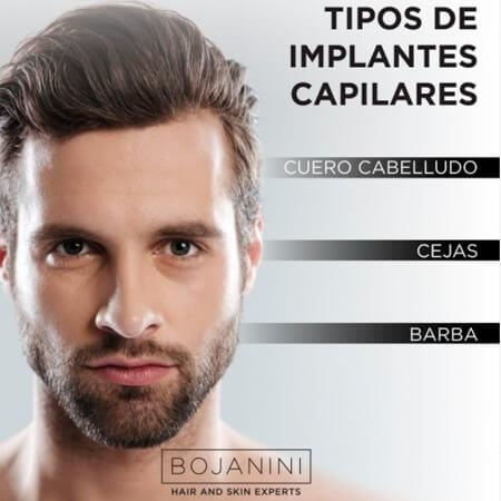Implantes capilares 