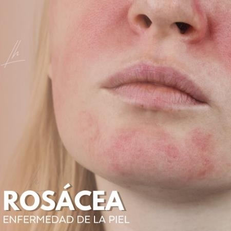 Specialized treatment for rosacea