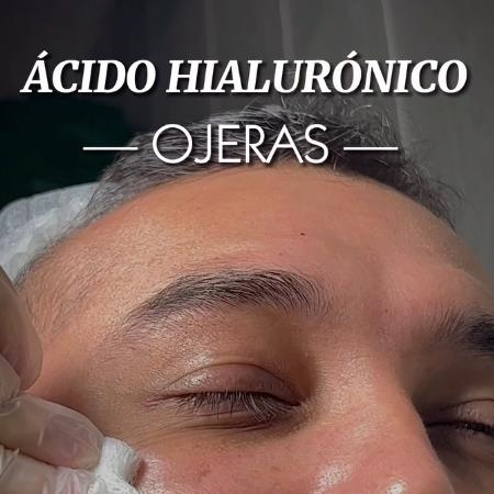 Eliminate your dark circles with our hyaluronic ac