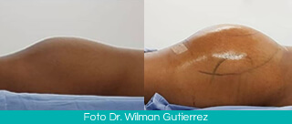 Gluteoplasty Colombia