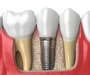 Guía para pacientes de Implantes dentales en Barranquilla