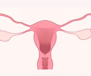 El Dr. Juan Federico Zapata nos habla acerca la endometriosis