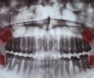 Wisdom teeth extraction by maxillofacial surgeon José Fernando Fragozo