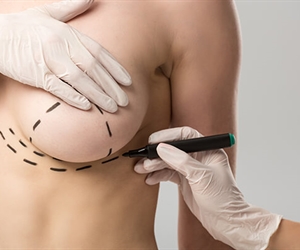 Breast surgery in Colombia - Everything you need to know Prices 2023