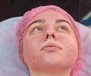 Phototherapy for dermatitis, psoriasis, acne by the dermatologist in Cali
