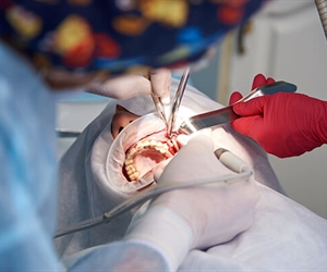 Implantes dentales por cirujano maxilofacial en Barranquilla