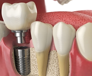 Implantes dentales en Colombia - Turismo dental - Precios 2024
