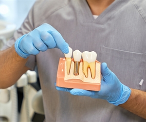 Implantes dentales en Cali, precios e información 2023