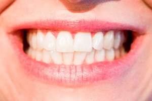 5 cosas que debes saber acerca del Blanqueamiento Dental