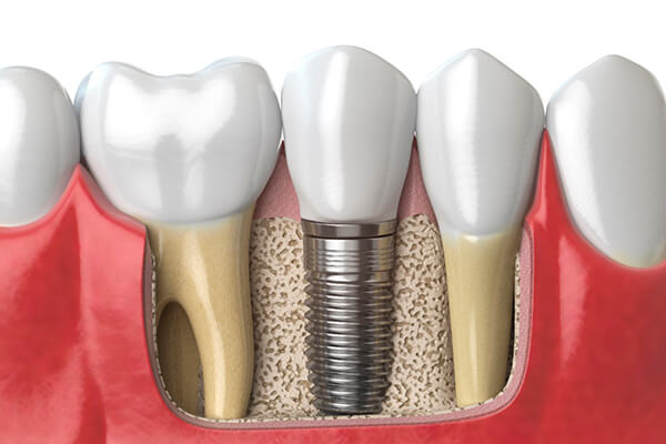 Guía para pacientes de Implantes dentales en Barranquilla