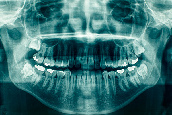 Radiografía panorámica dental en Barranquilla