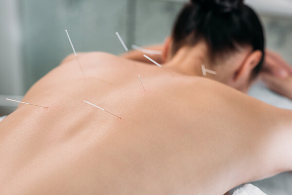 La acupuntura china para el alivio del dolor en Cali