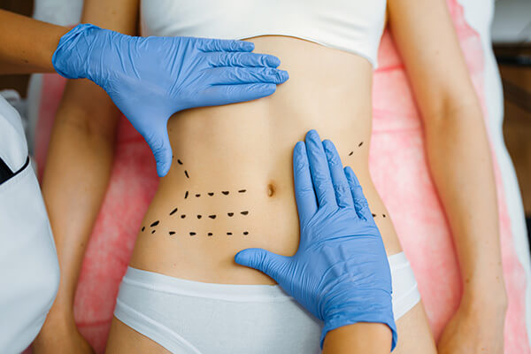 Tummy tuck in Colombia