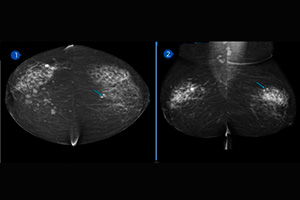Utilidad de la mamografía con contraste I.V en multicentridad y multifocalidad