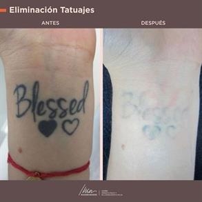 Tattoo Removal colombia