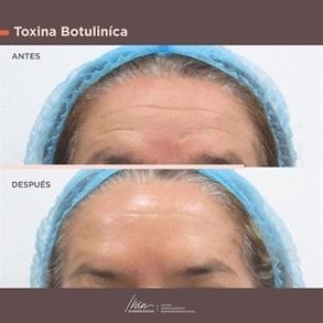 Wrinkles Treatment colombia