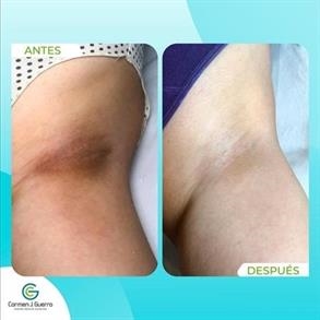Armpit whitening colombia