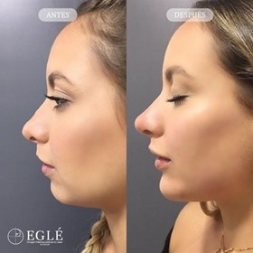Non surgical rhinoplasty colombia
