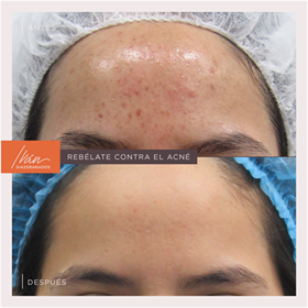 Acne treatment Colombia