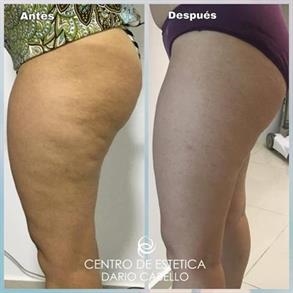 Cellulite treatment colombia