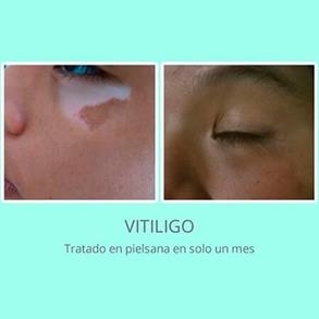 Tratamiento para vitiligo