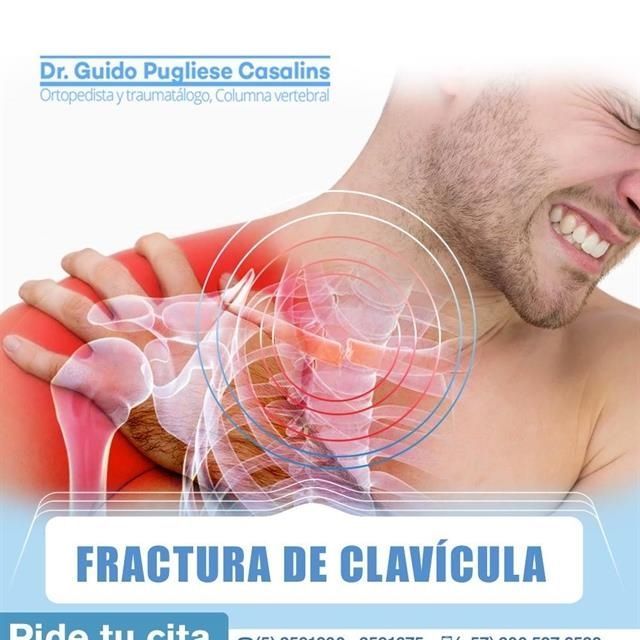 Clavicle fracture