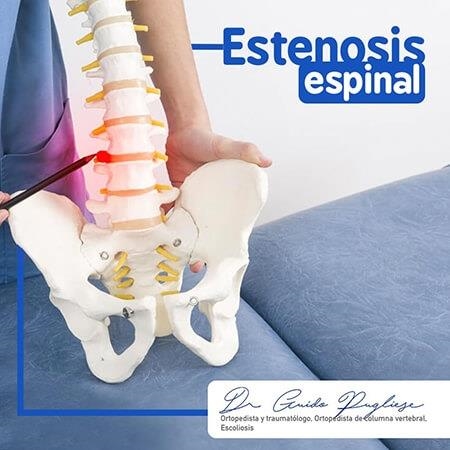 Estenosis espinal 
