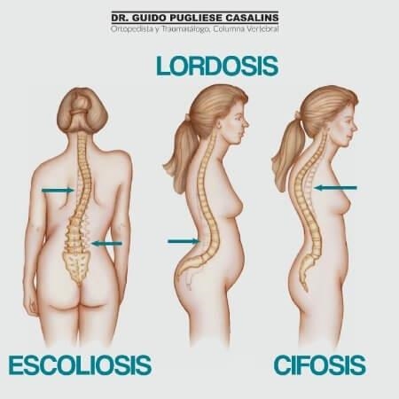 Scoliosis, lordosis and kyphosis