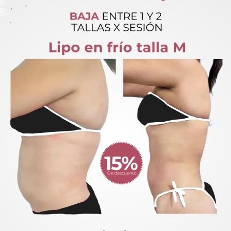 Transforma tu figura con nuestra Lipo en Frío