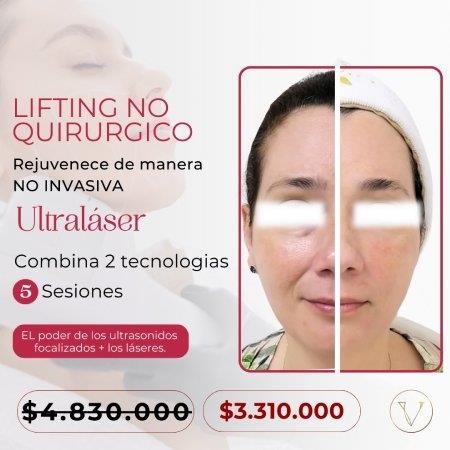 Lifting No Quirúrgico: Rejuvenece con Ultralaser