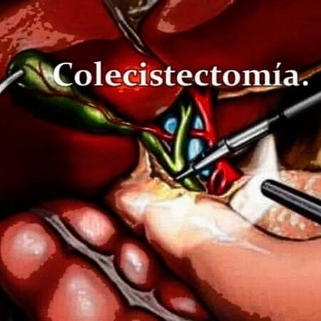Colecistectomía