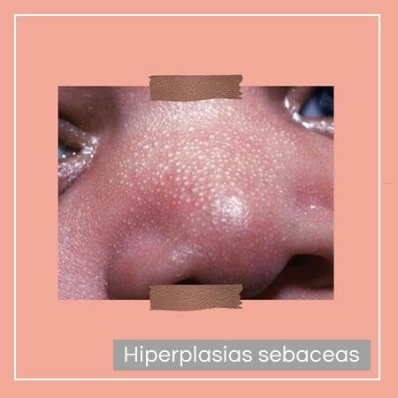 Sebaceous hyperplasias