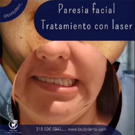 Facial paralysis