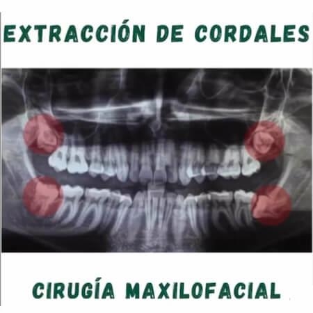 Wisdom tooth extraction in Barranquilla 