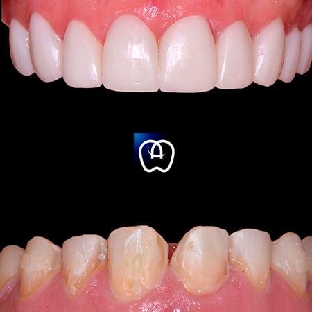 Dental veneers