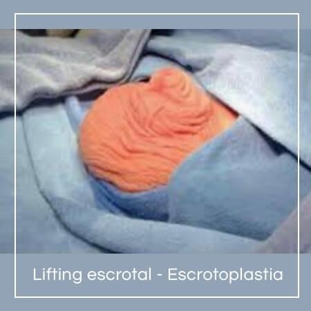 Scrotal lift - Scrotoplasty