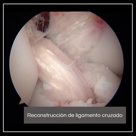 Anterior cruciate ligament reconstruction