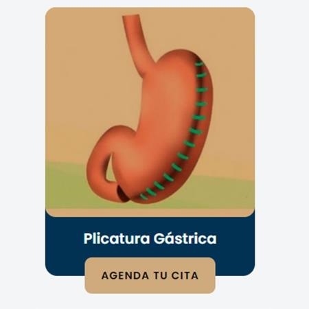 Gastric plication