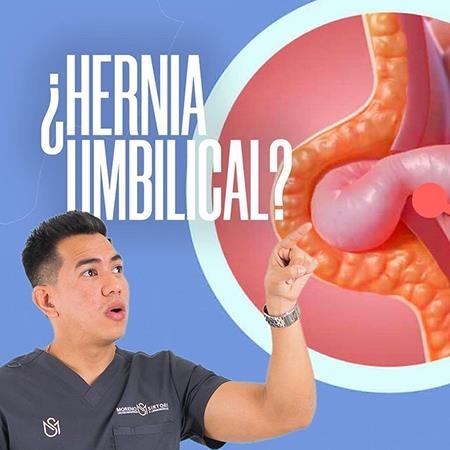 Hernia umbilical 