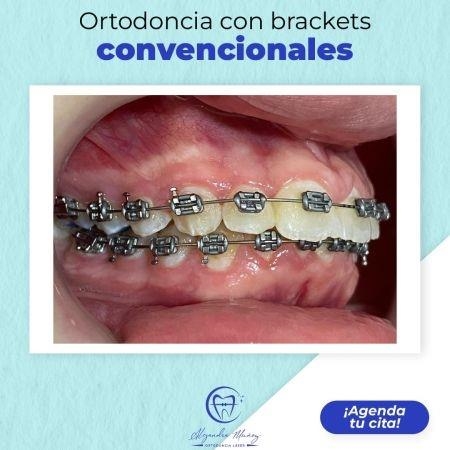 Orthodontic treatment with conventional braces