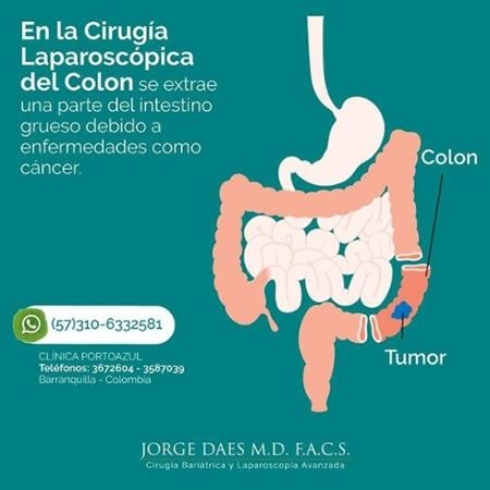 Cirugía laparoscópica de colon 