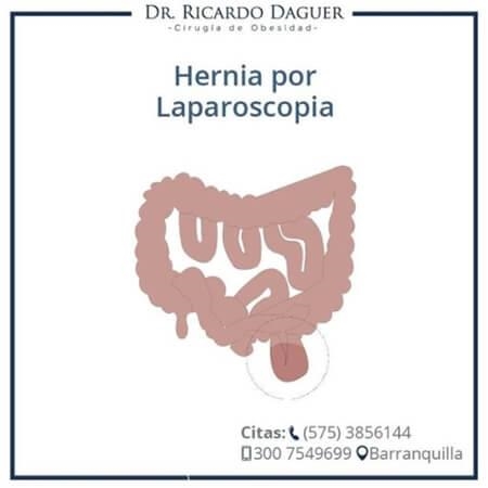 Laparoscopic hernia