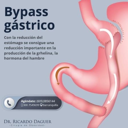 Bypass gástrico 