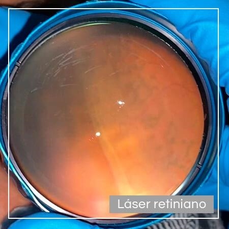 Láser retiniano